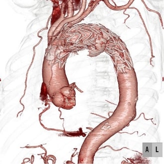 ステントグラフト挿入後CT
