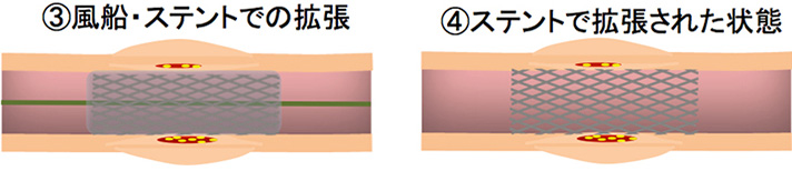 カテーテル治療2