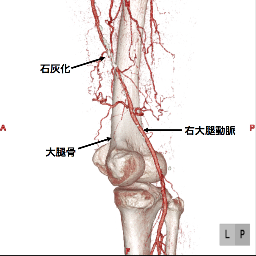 【図2】下肢造影CT検査 この画像は血管の立体的な走行の把握に有用です。 右足大腿部の血管に強い石灰化（動脈硬化の変化）があります。