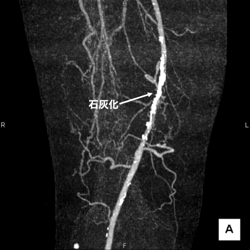 【図3】下肢造影CT検査 この画像は血管の立体的な走行の把握に有用です。 右足大腿部の血管に強い石灰化（動脈硬化の変化）があります。