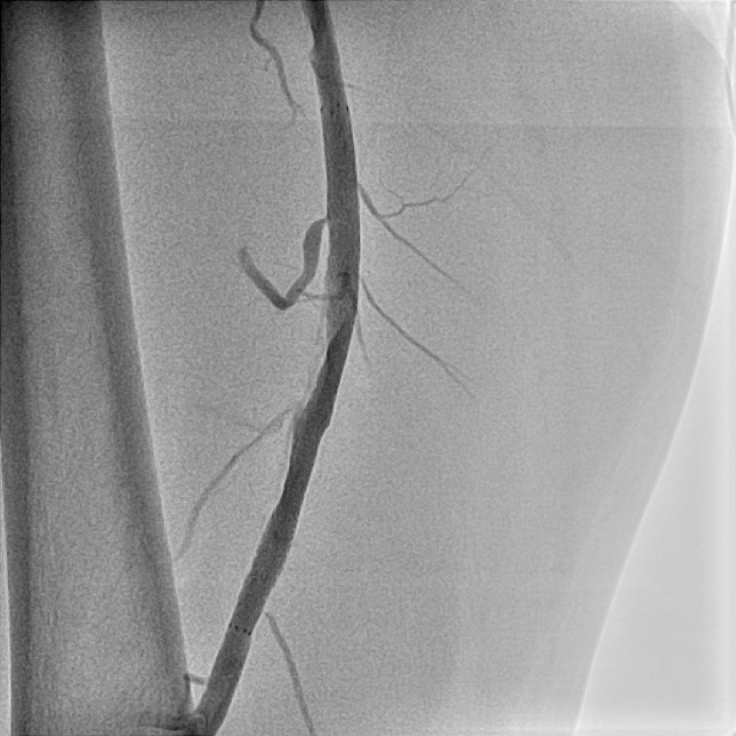 【図8】治療後CT検査 血流が維持されていることがわかります。 CT検査は治療後の経過観察するにも有用です。