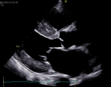 心臓の形や大きさ、動きの程度などが正確にわかります。