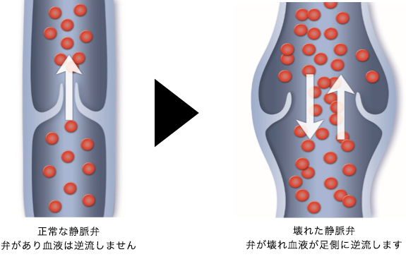 下肢静脈瘤とは