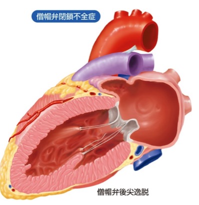 腱索断裂による僧帽弁閉鎖不全症の例
