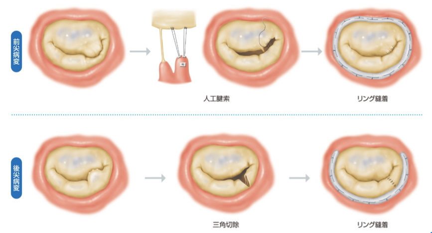 僧帽弁形成術の例