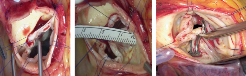 大動脈弁形成術の例