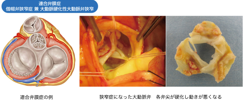 連合弁膜症の例