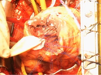 心室中隔穿孔に対するInfarct exclusion法の一部