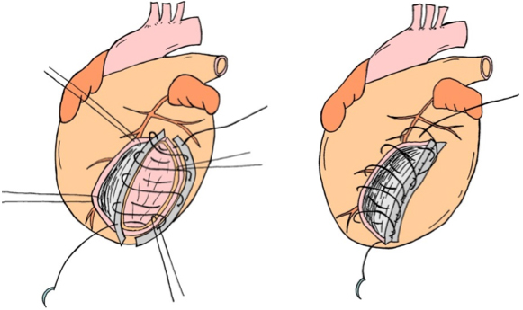 左室形成術（オーバーラッピング法）