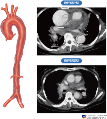  大動脈解離に対する外科治療