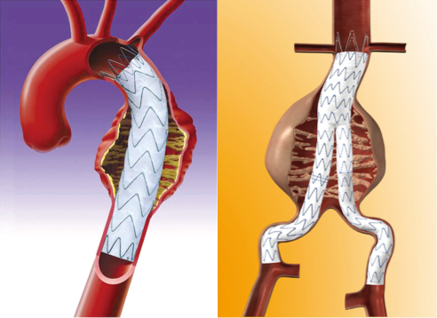 ステントグラフト内挿術