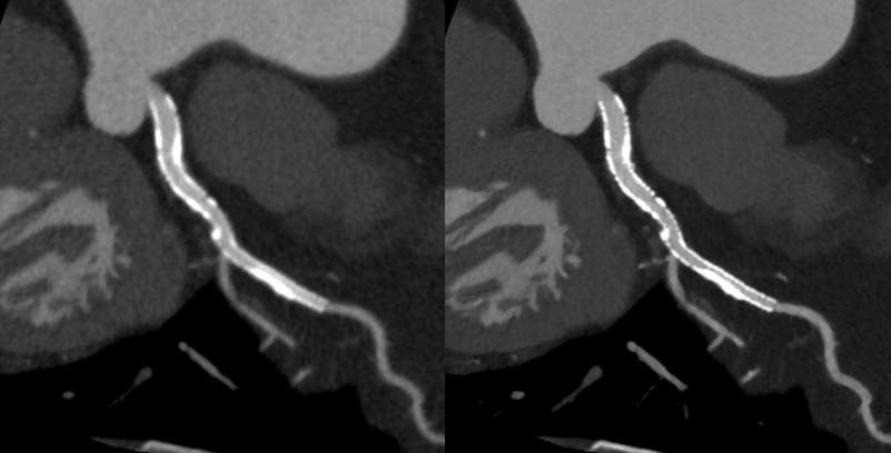 高精細画像再構成