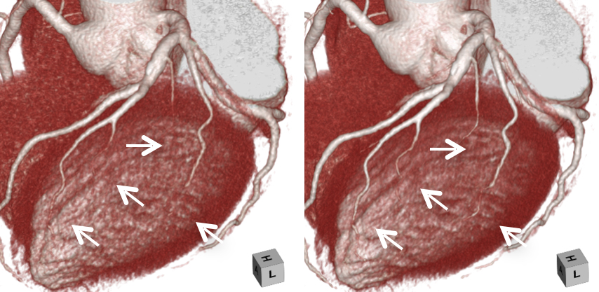 高精細画像再構成