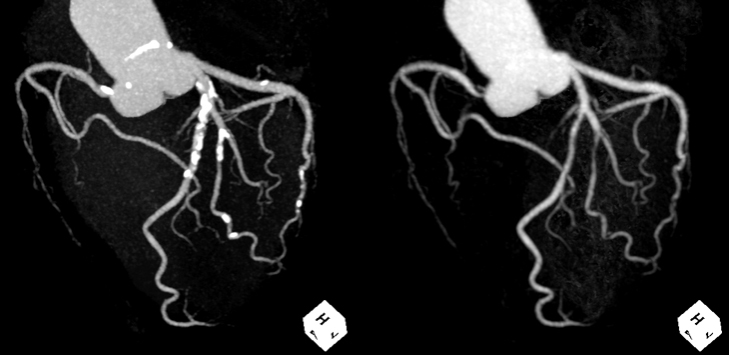 サブトラクション冠動脈CT