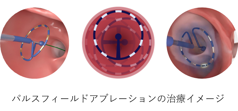 パルスフィールドアブレーションの治療イメージ