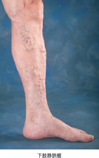 下肢静脈瘤